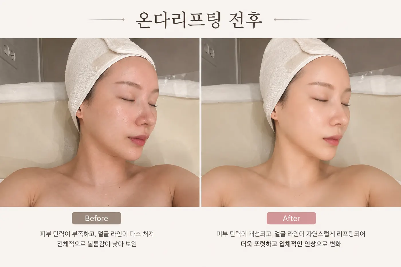 Re & Aesthetic 리엔에스테틱 — 온다 웨이브 리프팅 전후 — 얼굴 윤곽