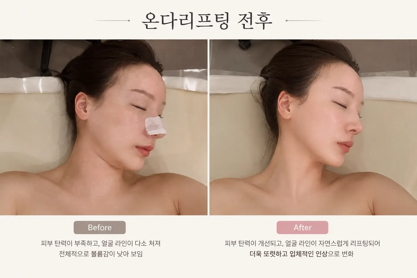 Re & Aesthetic 리엔에스테틱 — 온다 웨이브 리프팅 전후 — 턱선